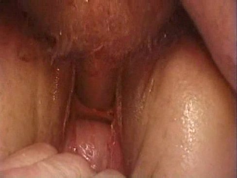 best of Bladder peehole sounding fuck with creampie