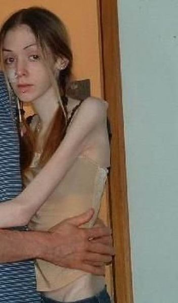 Anorexic Girl Porn